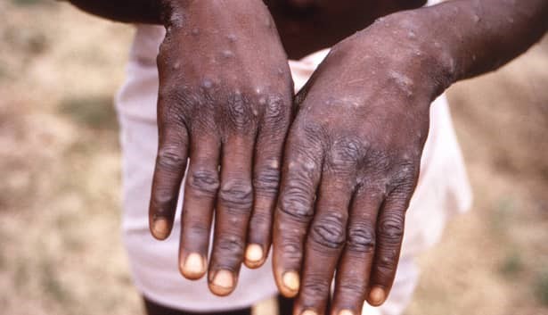 Read more about the article Health Authorities Confirm First Case of Monkey Pox     