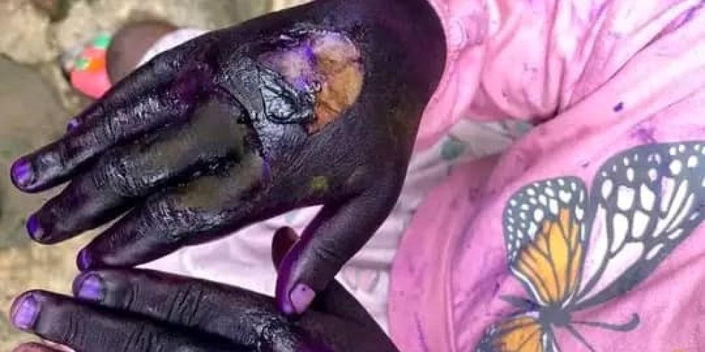 Aunt Set Hands of Nephew Ablaze