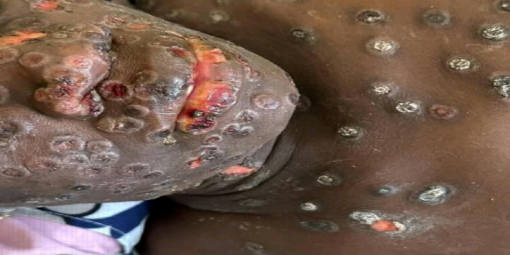 Mpox - Sierra Leone’s Urgent Battle Against a Growing Epidemic h